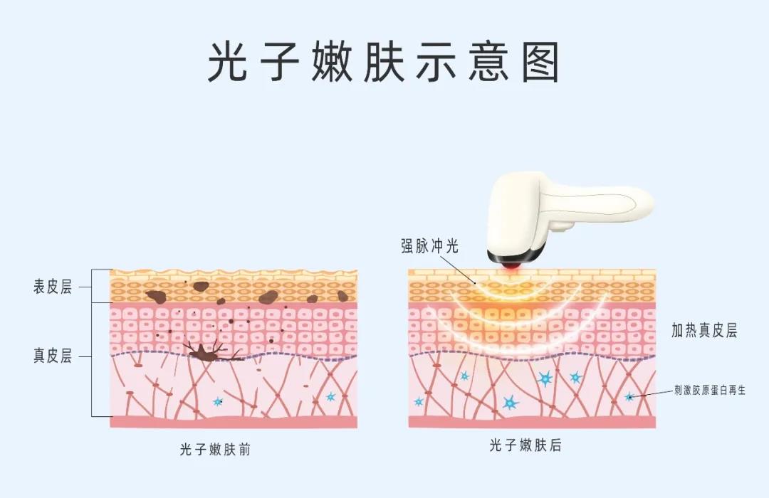 做好術(shù)后修復(fù)，拒絕“無效醫(yī)美”